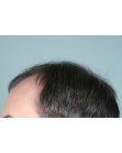 Before Hair Transplant&nbsp;2 Sessions (Areas)